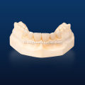 Advanced na Dental Emax Onlays para sa Pagpapanumbalik
